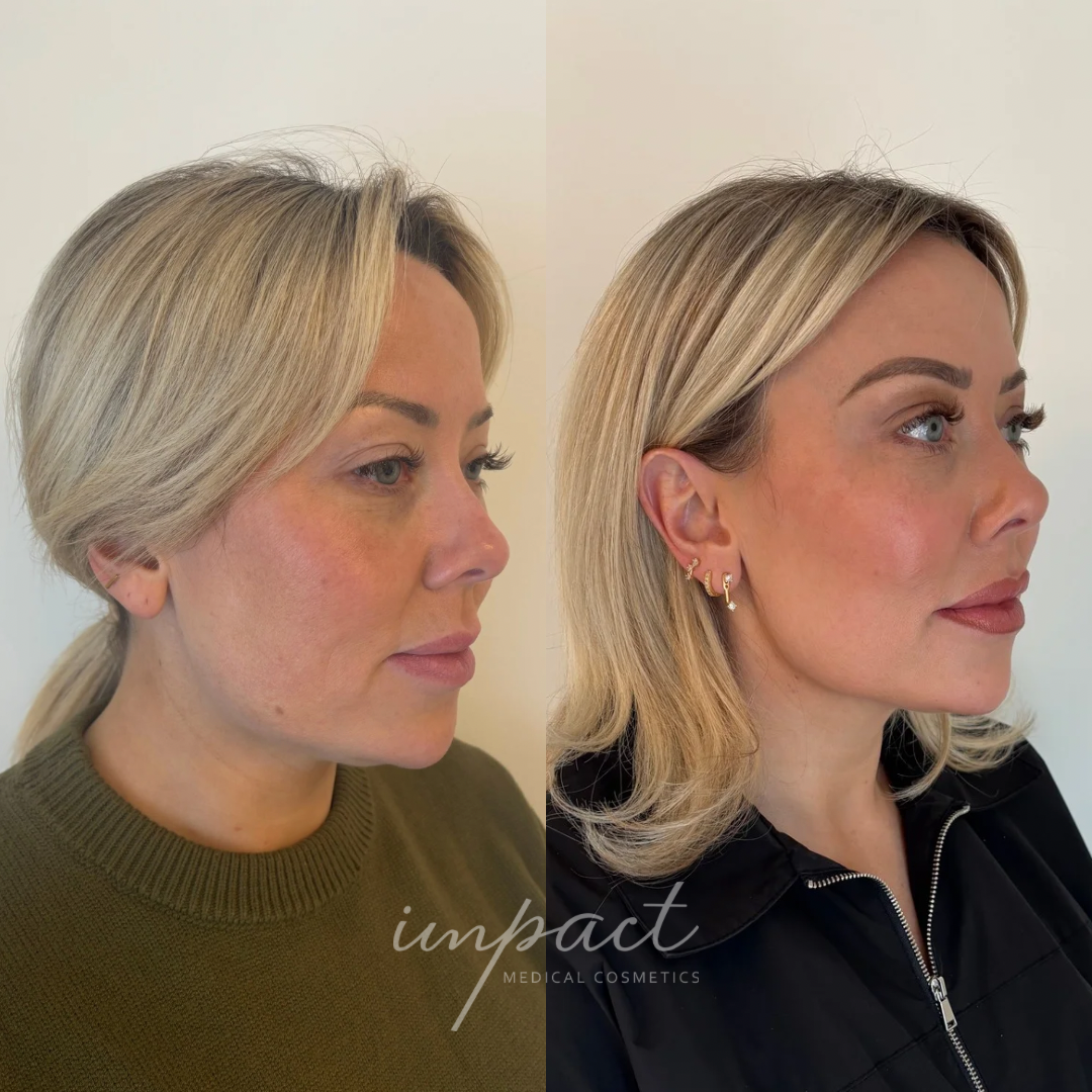 Facial Balancing Dermal Filler - Event Preferred Pricing (2+ Savings Applied at Checkout)
